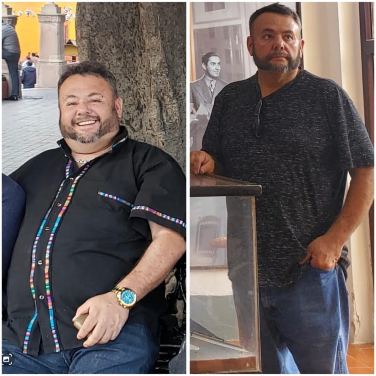 Antes y después de cirugía bariátrica en Querétaro