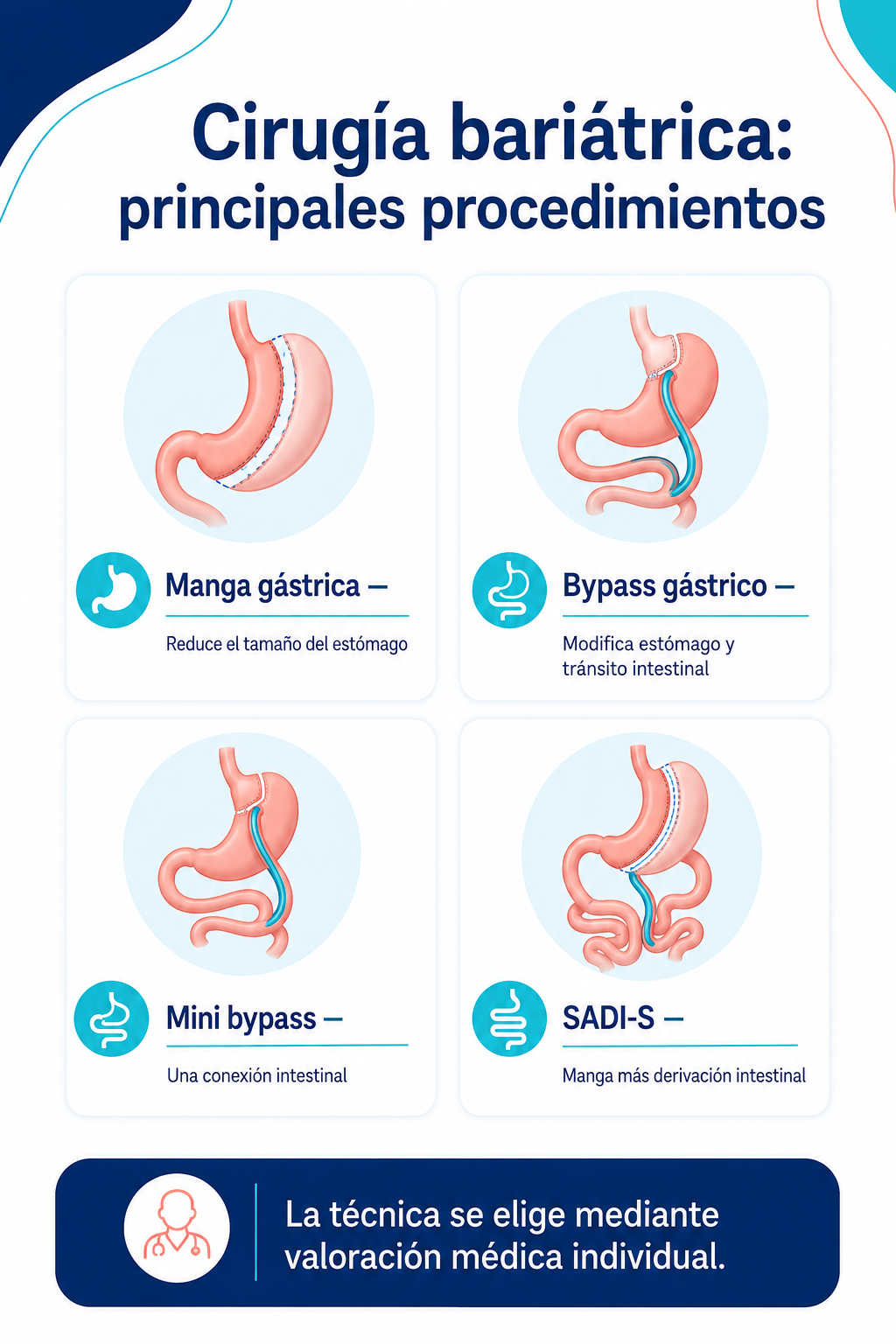 Comparación visual de manga gástrica, bypass, mini bypass y SADI-S