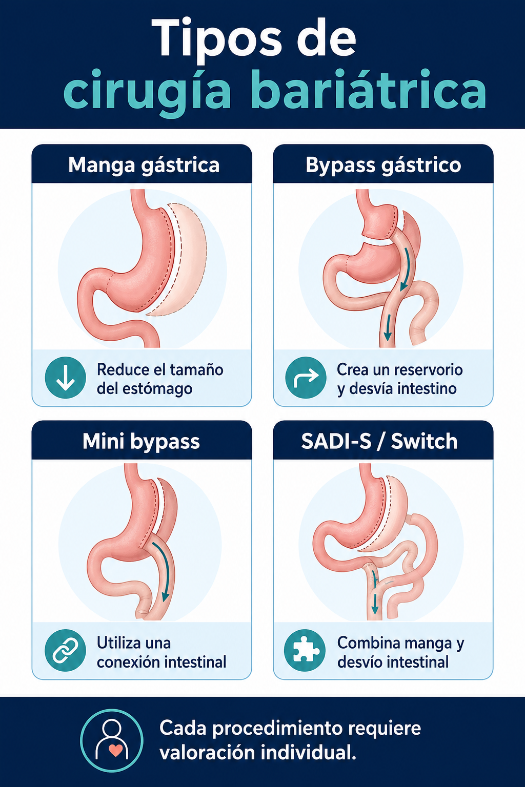 Comparación de tipos de cirugía bariátrica